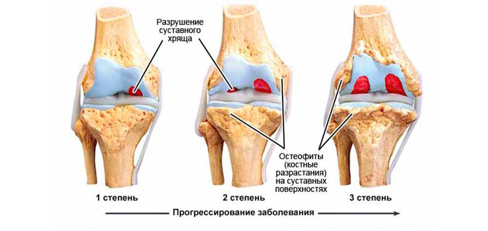 При гонартрозе необходимо исключить. Деформирующий остеоартроз коленного сустава степени. Гонартроз коленного мкб. Артроз остеофиты тазобедренного сустава. Посттравматический гонартроз 1 степени.